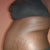 side view before surgery