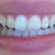 My smile - tray #6