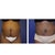 Before and 3 months after surgery!  Yeahhhhhhhhhhhh