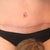 Never-mind my daughter's head. She wanted to be in the pic. LOL Here are my scars. (my underwear is folded down) Not my dream results, but DEF worth having vs. the baby blubber. Remember from my previous update, everyone scars differently. And my scars are improving everyday. :)