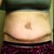 12 days post op TT