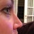 2 weeks after shots. I notice that the stubborn swelling has come down on the profile :)
