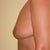 Day 3 Post Op, right side. A little droopy but nothing a bra can't fix