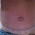 scar around bottom half of belly button