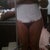 Day 1 post-op front