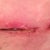 Front TT incision. Note slightly open, pus-like area, and reddened skin.