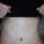 9 days post op in office standing up straight for the first time and saw my waist and swelling was gone! feeling discomfort but no pain. off pain pills now!