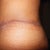 3 week revision scar left