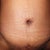 3 week revision - full scar. See how the left side is alittle more shapely than the right? Also, alittle puffy all above the incision. This is the end of the day so not sure if that is the reason.