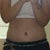 Post Op 1 week today