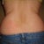 Back view, pre treatment