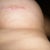 Left scar