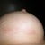 Right Scar