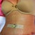 1 day post op