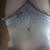This is about 3 weeks PO, not as swollen yet