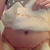 3Days post op I didnt take all the bandage off takes to long to put back on. I am rather swollen today. I hope that I dont get a dog ear it kind of looks like one but I am rather swollen...:(