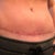 4 months post op