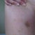 Here's a photo showing the bruising on my outer thighs one week after Ultrashape treatment.