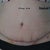 Day 12. I removed the drains. Still swollen