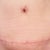 Front Scar..BB scar is fading quicker..hopefully I'll get the same results with the others.