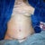 5 Days Post op, exhausted. Back is killing me. 1/14/13
