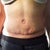 3 weeks post op