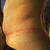 3 weeks post op