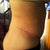 1 month Post Op Extended TT