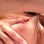 Right incision