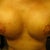 3 weeks post-op , looking better, starting to see a shape that I'm liking :) oh yeah and you can see the small pimple I'm taking about on my right one.