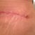 Left Scar 4wk 5days