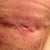 Hole I thought was spitting a stitch.  PS said it is not and it is fine.  Told me to put more Bacitracin on it several times a day. 4wk 5days