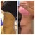 RIGHT: 5 weeks post op during the swelling from hell period (this is how I looked for a full 8 weeks) , LEFT: 12 weeks post op