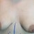 Breast Before