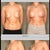 Left before, right 7 weeks po