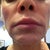 No bruising on lip or cheeks