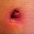 Up close of bb (scar is in pink stage)