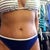 7 months PO. Front bikini view.