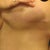 9 months Scars under left breast