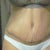 19 days post op, lots of swelling..especially towards the incision and hips