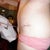3 days post op