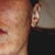 Two years after still have white lines and started getting open sores