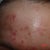 Today 20 months after MTZ DNA DAMAGE