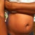 Before Surgery