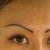 Post botox