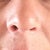 Day 10:  Uneven nostrils.  I hope this is swelling!