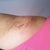 Day 20:  Left Armpit incision.  Looking good and healing great!
