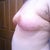 Day 20:  Left breast side view.