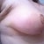 Day 20:  Right breast side view (this one was harder to take since I'm right handed lol).  My armpit looks weird since the puckered stitch and puffiness at this point.