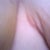 Day 20:  Close up of the problem area!  Thoughts on what it is/what I can do to help get rid of the ugly puffy area??  I want it to look great like the other side!  Will it change and look smooth with time and as my breasts change shape/soften to a more natural shape?